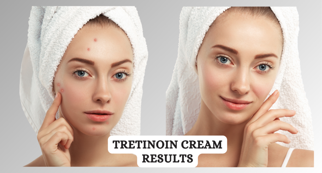 Tretinoin Cream Results